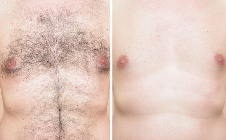 Chest,Of,A,Man,Before,And,After,Trimming,Chest,Hair