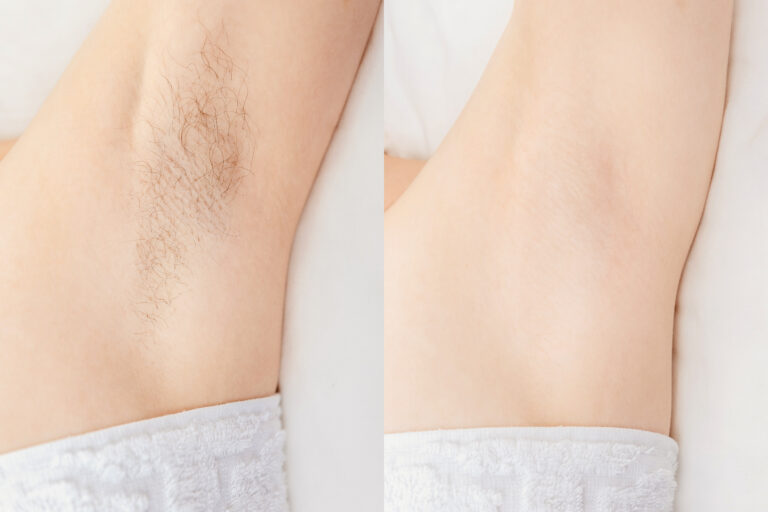 Women,Underarm,Hair,Removal.,Concept,Before,And,After,Shaving,Sugar